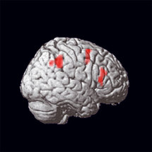 Hypnose: le cerveau observé sous hypnose Hypnose: le cerveau observé sous hypnose